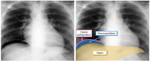 Radiografia de tórax em ortostase - pneumoperiônio. (Raio-x de abdome)