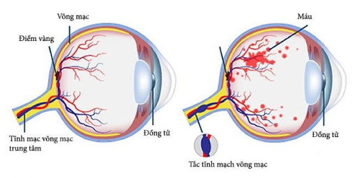 Tắc tĩnh mạch võng mạc
