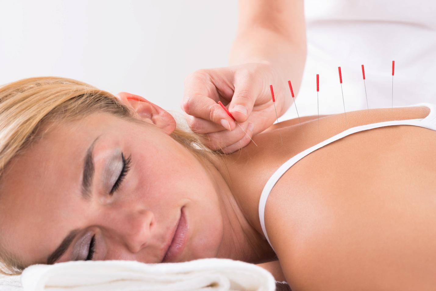 acupuncture in Richmond Hill