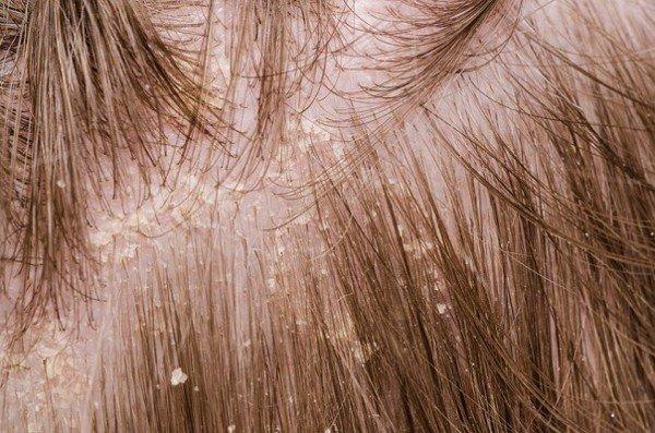 cách trị gàu triệt để, dầu gội thảo dược gừng dừa cỏ cây hoa lá làm sạch gàu hiệu quả chỉ sau 7 ngày