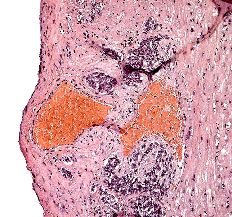 Peritoneal surface of uterus with perivascular trophoblastic infiltration.