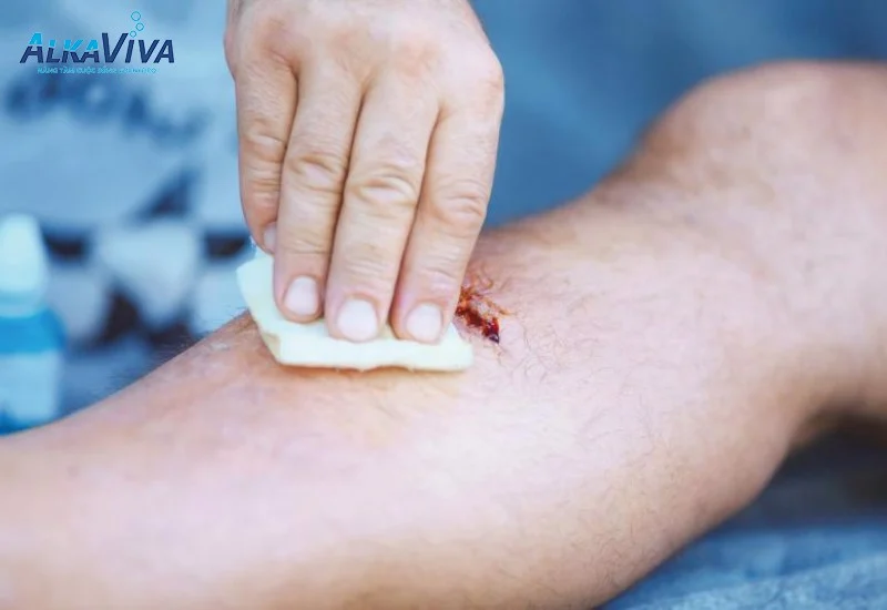 LỢI ÍCH KHI SÁT TRÙNG VÀ KHỬ KHUẨN BẰNG NƯỚC ION KIỀM ALKAVIVA PH 3.5