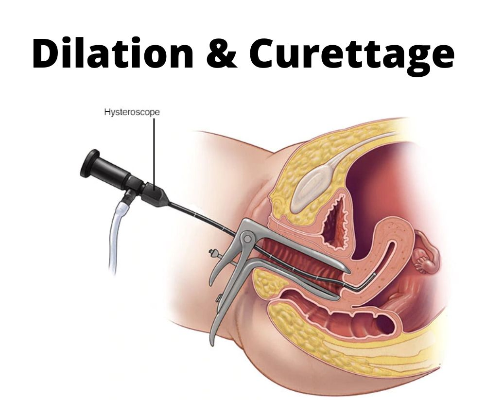 Dilation & Curettage (D&C)