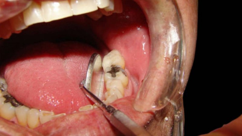 Tủy răng bị viêm là một trong những nguyên nhân khiến răng ê buốt
