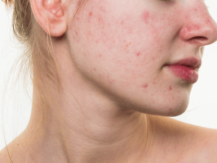 Giải mã 14 hiểu lầm về mụn