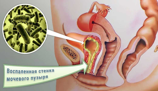 Лечение посткоитального цистита в Симферополе Крым
