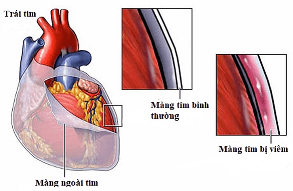 Viêm màng ngoài tim: biểu hiện, chẩn đoán và điều trị - YouMed