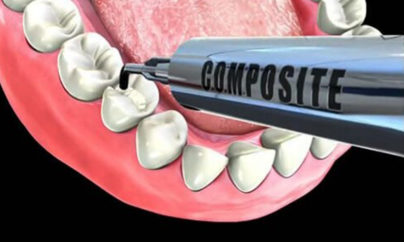 Composite là vật liệu cao cấp, độ bền và thẩm mỹ tốt