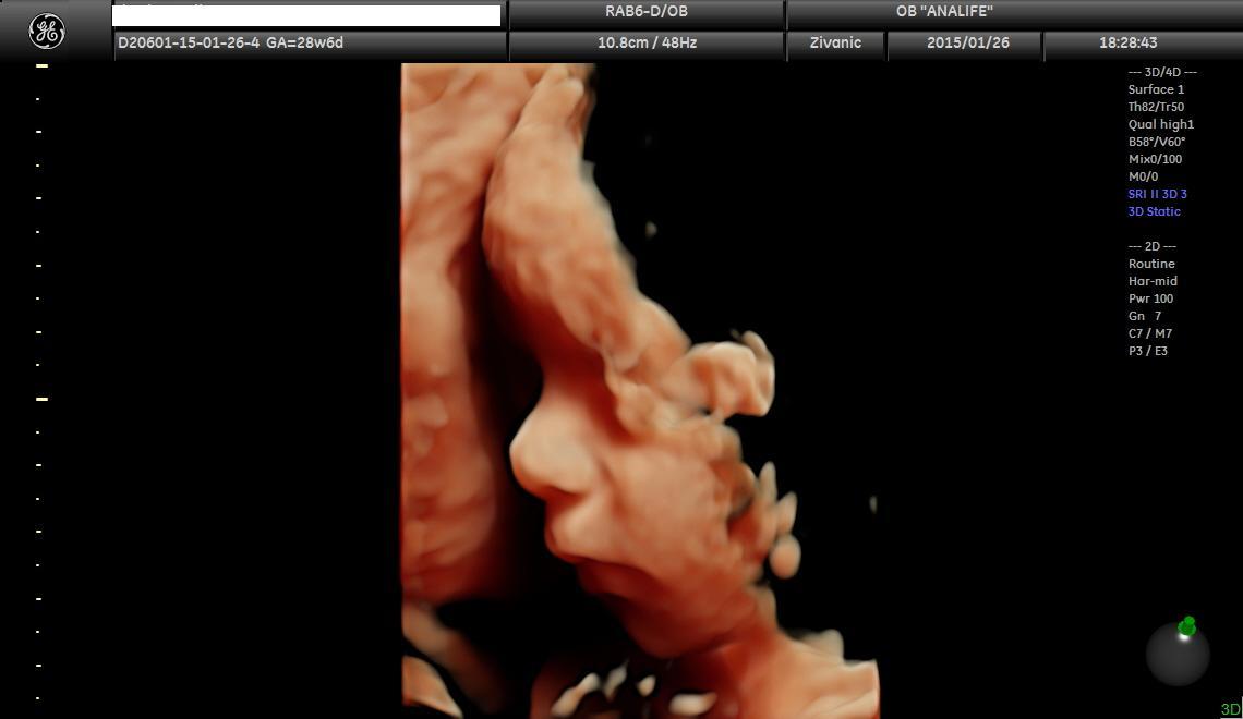 1553511480_24.trudnoca-ekspertski-4D-ultrazvuk-od-25-27-nedelje-trudnoce-galerija.jpg