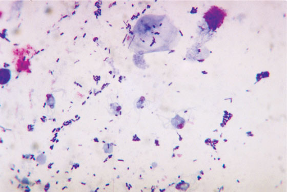 Stained slide preparation of trichomoniasis (arrows)
