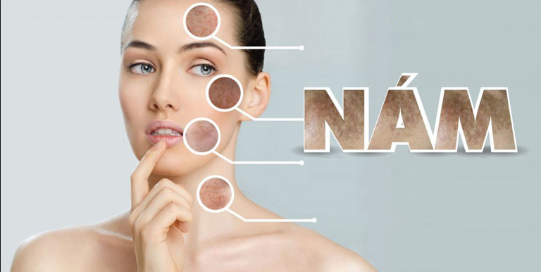 Nguyên nhân gây nám da ở phụ nữ