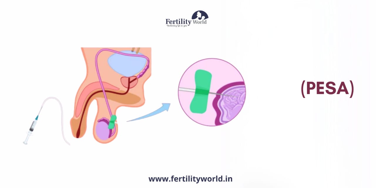 IVF with PESA treatment