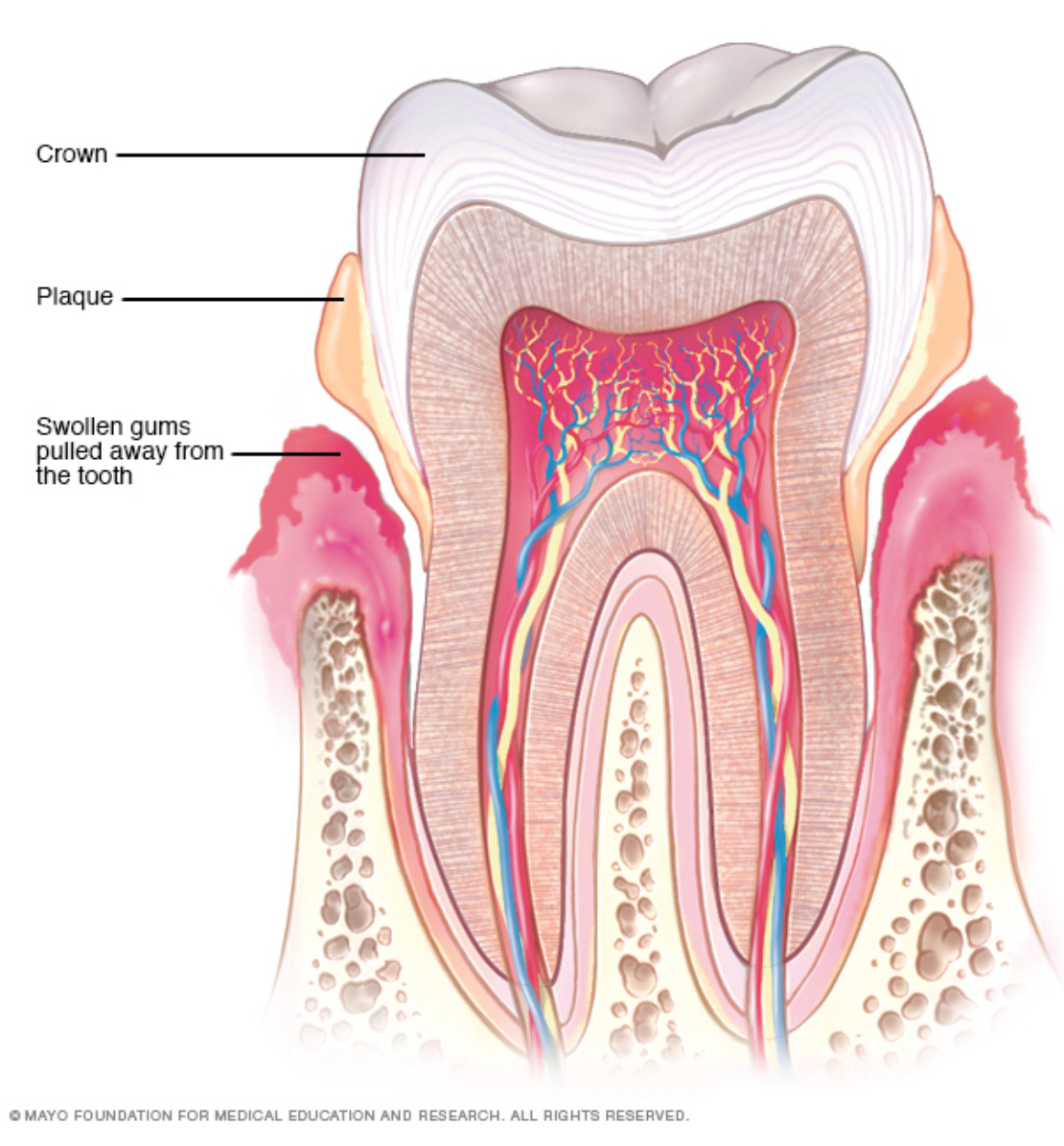 Костная основа полости рта. Периапикальный периодонтит. Мышьяковистый периодонтит.