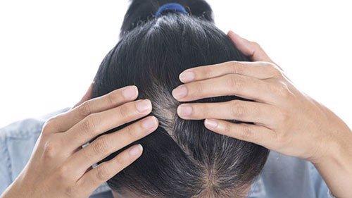 đâu là cách chữa tóc bạc sớm hiệu quả nhất