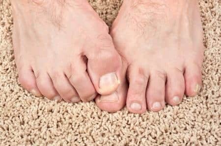 Leukonychia causes white streaks or spots on toenails