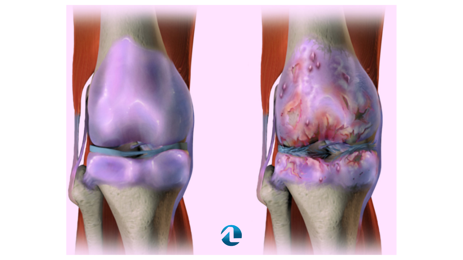 tratamento para artrose no joelho