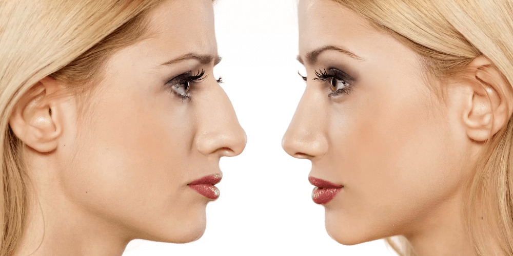 Rhinoplastie avant et après