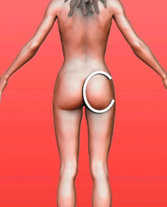 Buttock Enhancement Techniques*