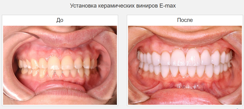 эмаль на поверхности зуба
