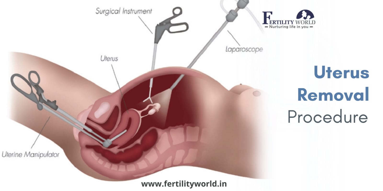 How is the uterus removed via Laparoscopic surgery?