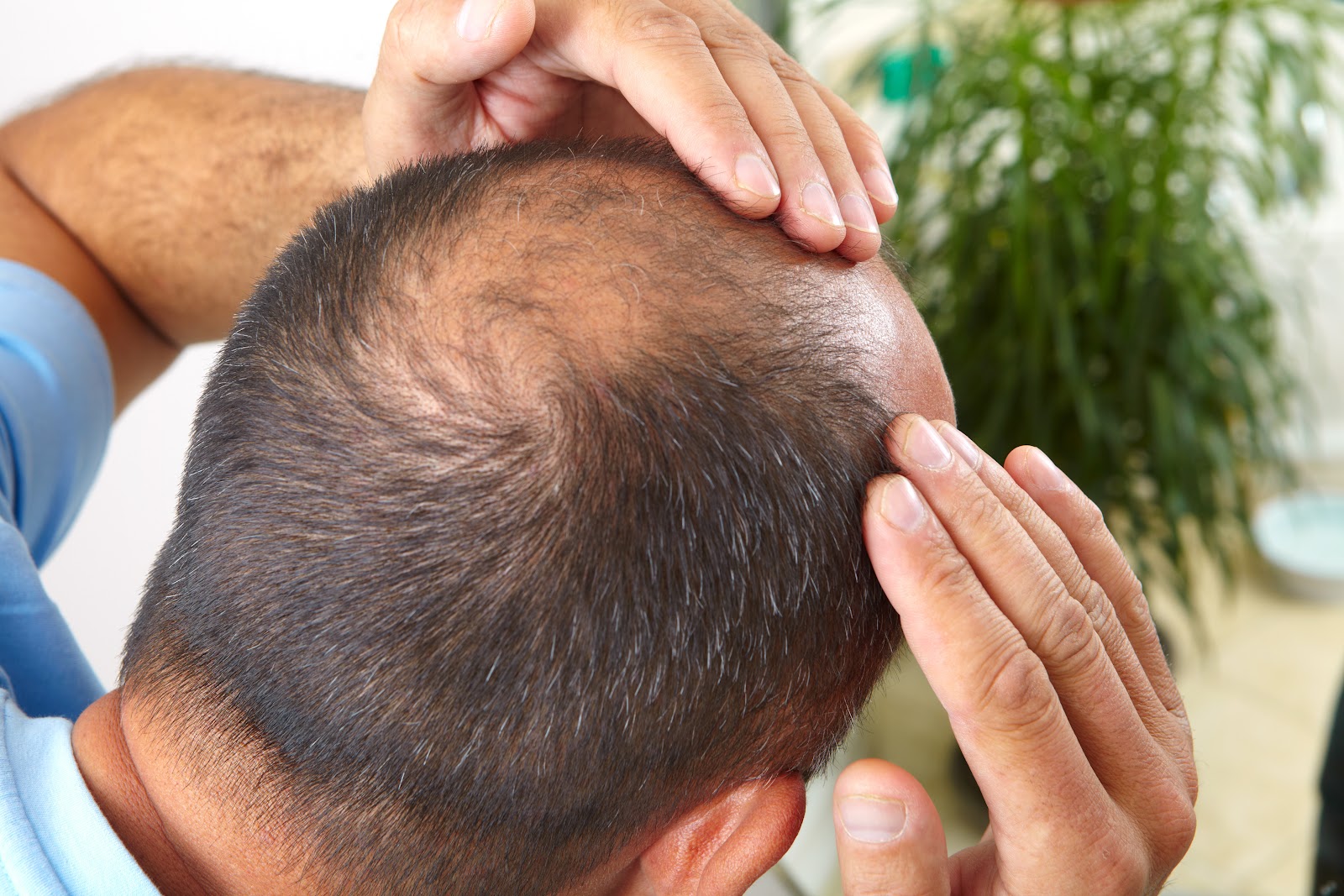 Căderea părului la bărbați, femei și copii - Cauzele calviției și  tratamente împotriva căderii părului