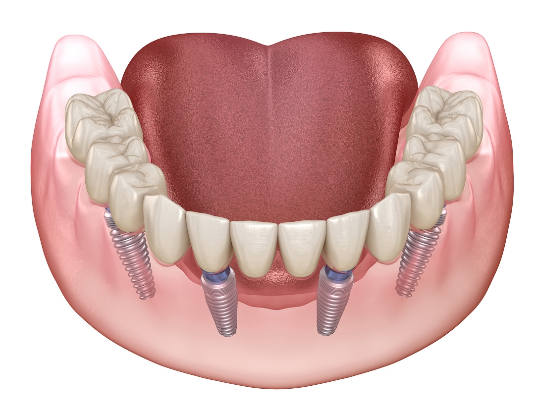 An All-on-4 dental implant.