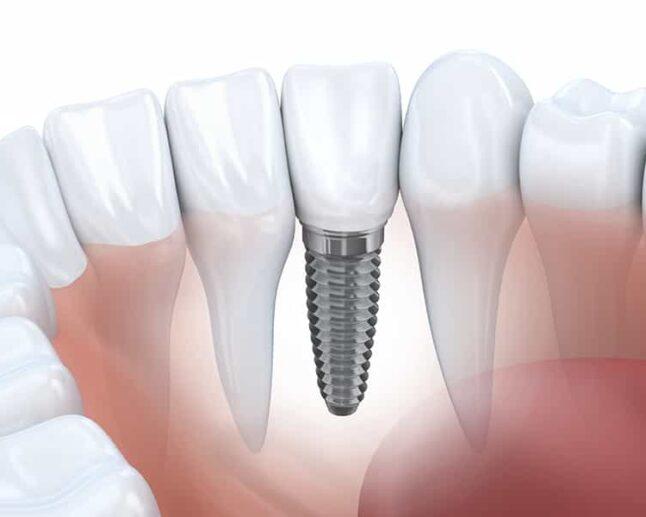 Виды имплантации зубов -1