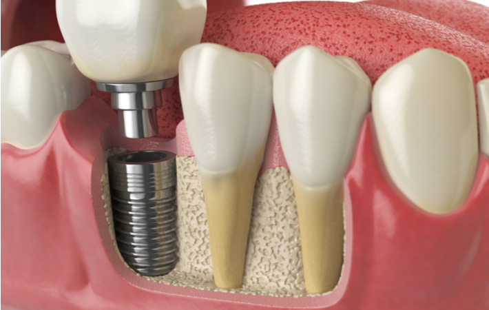 3d rendering of a dental implant being inserted