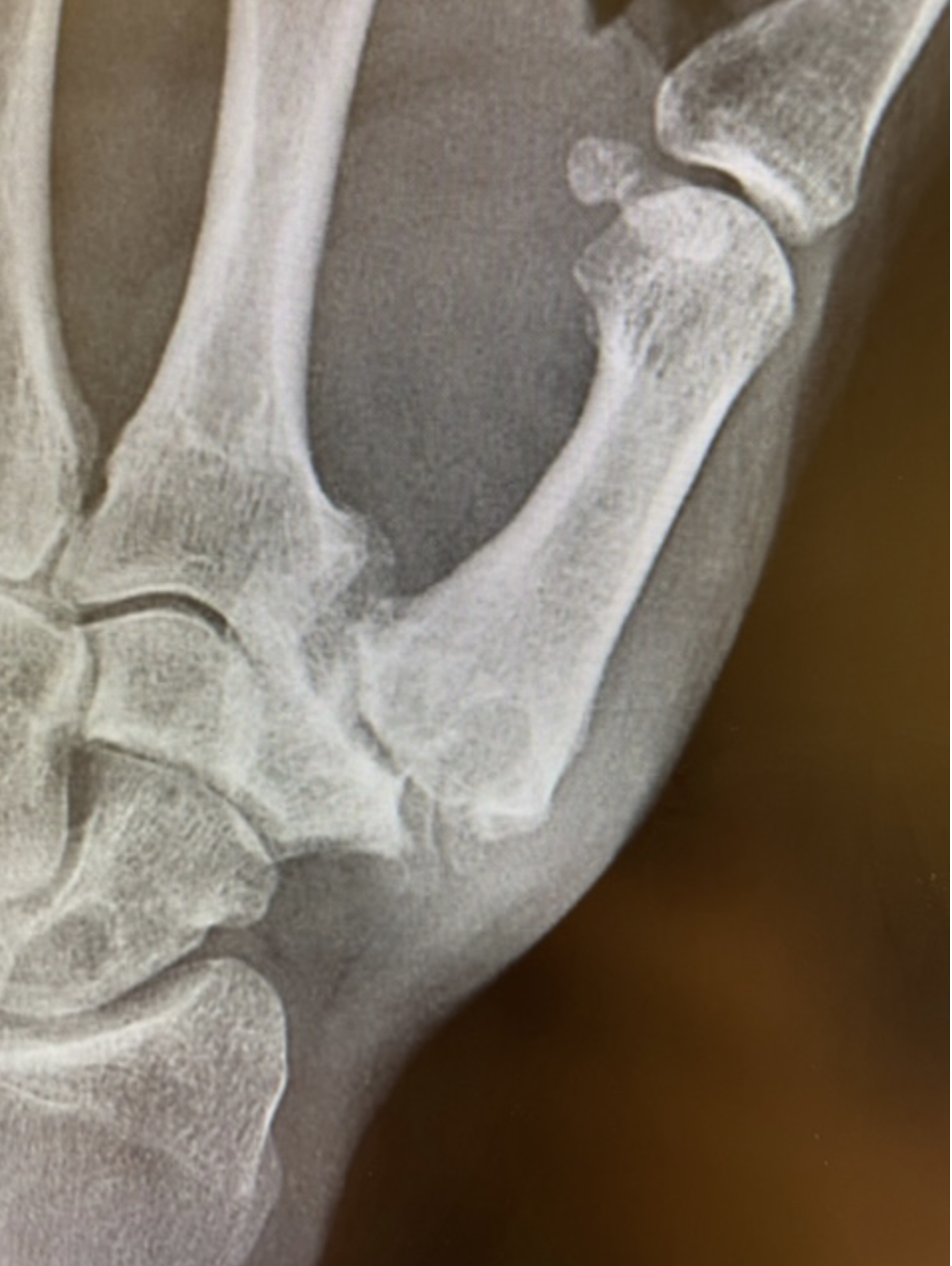 Thumb Arthritis Treatment Raleigh Hand Surgeon 