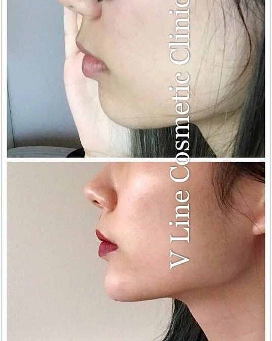 Before and After Transformation of Dermal Fillers Used For a Perfect Jawline