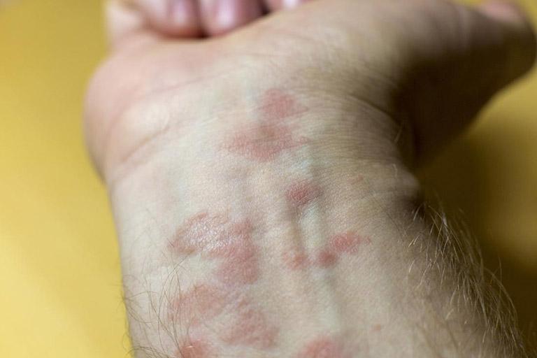 Bệnh Eczema là gì ? Nhận biết và điều trị thế nào đúng cách ?